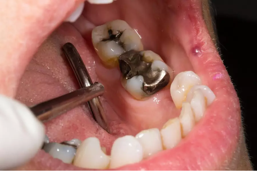 Чехия не будет применять запрет на использование амальгамы в зубных пломбах в ЕС с 2025 года